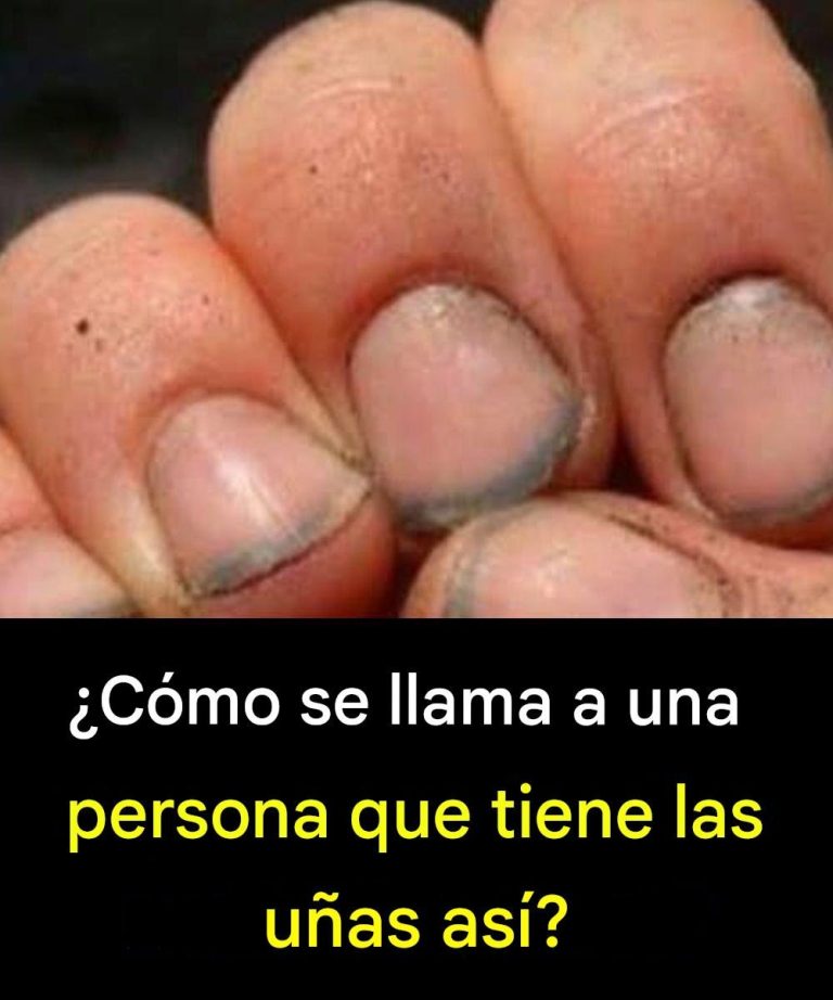 ¿Cómo se llama a una persona que tiene las uñas así?